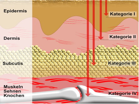 Grafik: Die vier Kategorien des Dekubitus